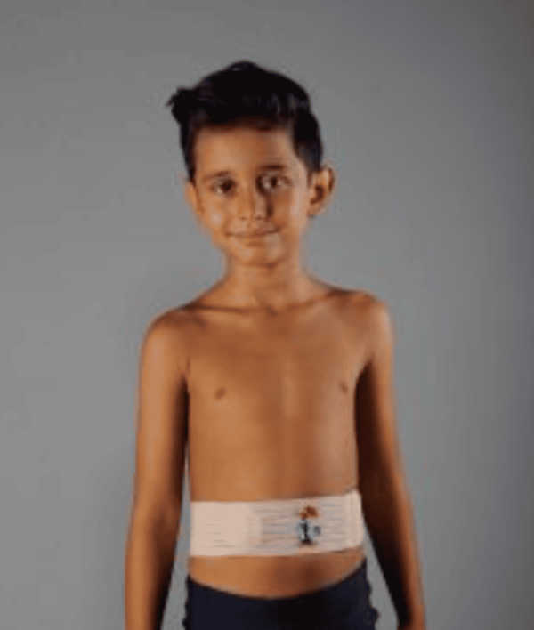Corset Pour Hernie Ombilicale Chez Les Enfants
